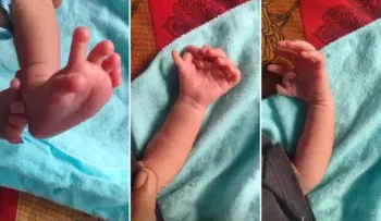 Padres con bebé de 26 dedos creen que se reencarnó en una diosa hindú