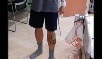 Increíble: Lo muerde una serpiente, lo ataca un tiburón y dos monos, le cae un rayo, y sobrevive
