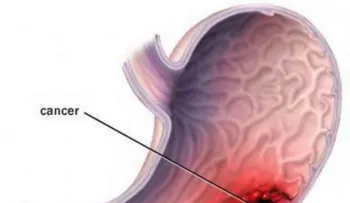 El cáncer de estómago: una enfermedad silenciosa: Sabes cuáles son los síntomas?