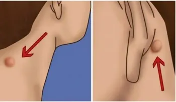 Si tienes esta pelotita detrás de tus oídos elimínala rápido con este remedio porque esto significaâ?¦