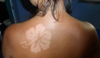 Los dermatólogos advierten del peligro de los tatuajes solares 