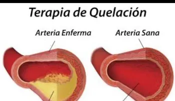 La quelación: Una técnica con excelentes resultados de desintoxicación del organismo. Beneficios de la terapia 