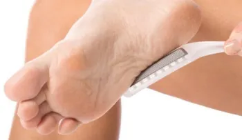 Los callos pueden ser dolorosos y molestos; cómo quitarlo de forma natural