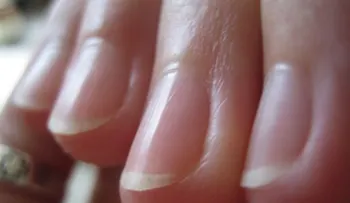 Comerse las uñas perjudica seriamente la salud 