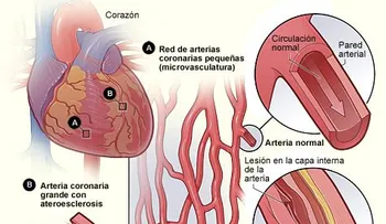 En R.Dominicana hay una epidemia de muertes por problemas coronario y de hipertensión