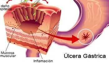La gastritis, causas y síntomas