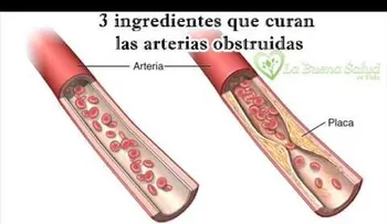 3 ingredientes que curan las arterias obstruidas (VIDEO)
