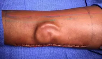 Médicos le crean una oreja en un brazo a soldado que la perdió en un accidente