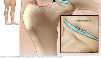 Desgarro del labrum de la cadera: causas, síntomas y tratamientos