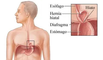 Hernia de hiato: ardor, dolor de pecho, o dificultad para tragar. Puede afectar a personas de cualquier edad 