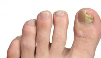 6 simples remedios para eliminar los hongos de las uñas