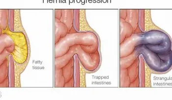 Hernias abdominales son comunes, pero no necesariamente peligrosas