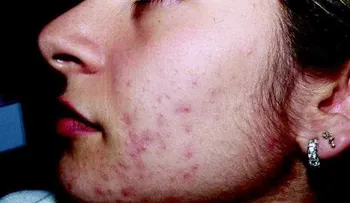 Qué es hirsutismo: definición y concepto, causas y tratamiento