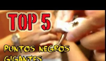 Más de 10 años con un punto negro en la oreja y nunca imaginó lo que saldría de ahi...