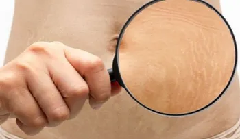 6 trucos para mejorar el aspecto de tus estrías