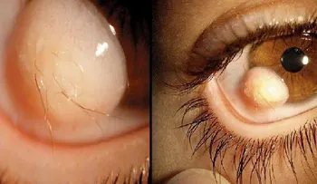 Mujer perdió la vista del ojo derecho por usar este Rímel