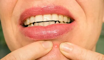 Lo que significa el acné en diferentes partes de la cara