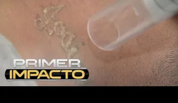 Los tatuajes ya no son para siempre; te lo puede quitar sin dolor y sin manchas