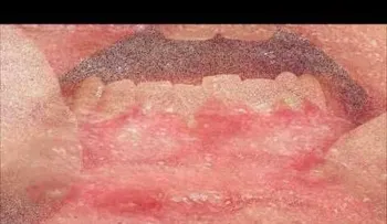 Como eliminar Herpes. Remedios Naturales