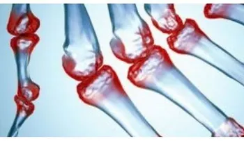 Esta mezcla cura para la artritis, reumatismo y enfermedades de las articulaciones