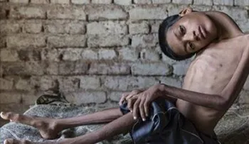 Este joven fue marginado por su horrible deformidad. Ahora luce así de increíble!