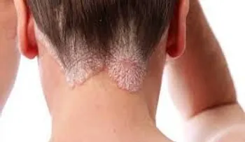 La psoriasis es más que una simple erupción 