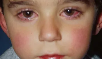 La conjuntivitis se ha convertido en viral y puede complicarse en niños