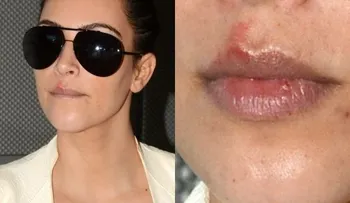 Kim Kardashian tiene herpes, y si tu tienes menos de 50 años, también puedes tenerlos 