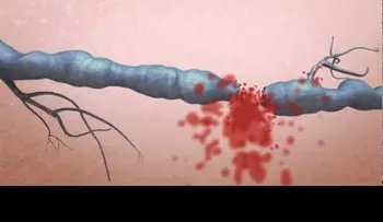Tratamiento de varices con Laser (Video) 