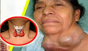 La cura para la tiroides la tienes en tu casa y los doctores las ocultan: ¡Wow es impresionante!