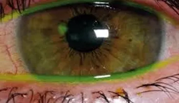 Abrasión corneal se produce cuando una córnea se lesiona y puede requerir de una operación