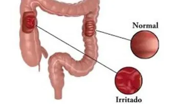 Dieta para el síndrome del intestino irritable: más común en mujeres, que hombres