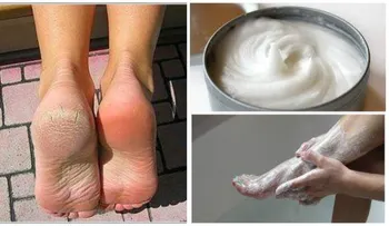 Quita los hongos y los callos de los pies con este increíble remedio. ¡Toma nota!