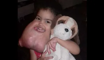 Cirujanos de EE.UU. remueven extraño tumor facial a niña brasileña