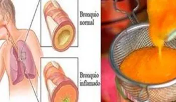 En 2 horas depúrate de la tos, gripe y flemas con este remedio