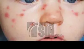  El sarampión es una enfermedad sumamente contagioso: ¿Sabe como se propaga ? 