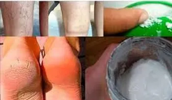 EL MILAGRO sucederá en 10 días: Remedio para curar los talones agrietados, los callos y las venas varicosas