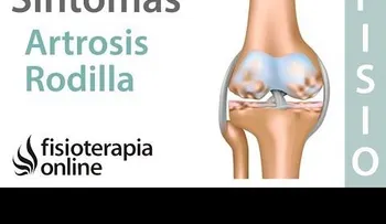  Artrosis o desgaste de rodilla - Qué es, causas, síntomas y tratamiento