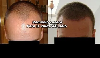 Remedio para la caída del pelo (funciona de verdad!!! ) (VIDEO)