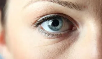 Conoce las posibles causas y soluciones para las ojeras