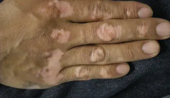  El vitíligo sí tiene cura