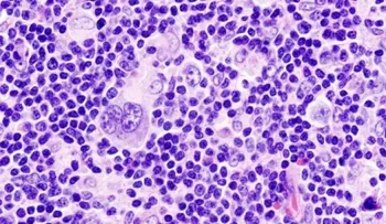 El cáncer en los glóbulos blancos afecta a 580,000 personas en el mundo