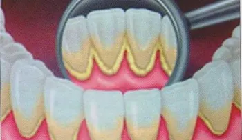 Causas del sarro en los dientes y cómo eliminarlo DEFINITIVAMENTE