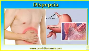 La dispepsia, tratamientos eficaz