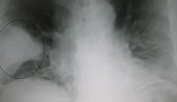Terapia revolucionaria corrige los defectos en la fibrosis quística