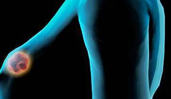 Un simple test podría evitar quimioterapia en 40% pacientes con cáncer de mama