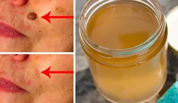 Quítate las verrugas, espinillas y las manchas por edad con este simple tratamiento