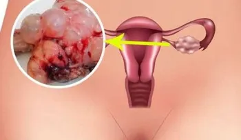 6 Síntomas del Síndrome de Ovarios Poliquísticos