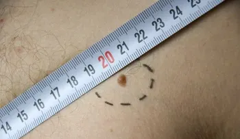 10 cosas que no sabías sobre el melanoma.