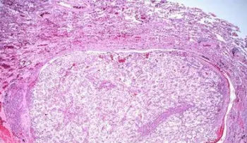 La metástasis sigue siendo el agujero negro en el tratamiento del cáncer